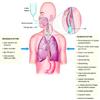 >Vấn đê viêm phổi ( VAP) trên bệnh nhân thông khí nhân tạo – Các đường lây nhiễm chính